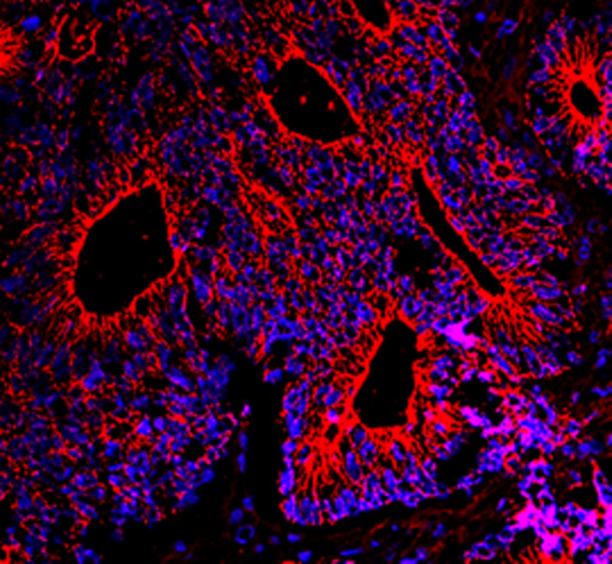 Dickdarmkrebs unter dem Fluoreszenzmikroskop