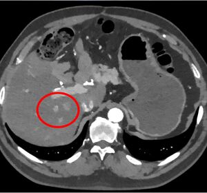 Patient mit Fieber und Verdacht auf Gallensteine