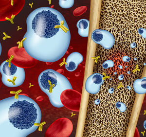 Patient mit Hochrisiko-schwelendem Multiplen Myelom