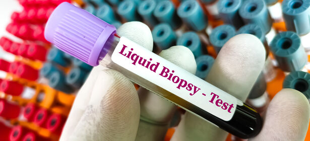 Liquid+Biopsy+bei+Lungenkrebs