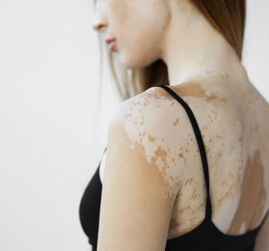 Vitiligo – eine behandlungsbedürftige Autoimmunerkrankung interdisziplinär betrachten