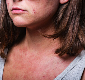 Atopische Dermatitis: Überlegenheit von Upadacitinib gegenüber Dupilumab