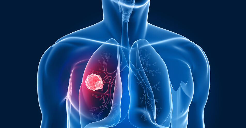 Durchbruch auf dem Weg zu einem Früherkennungsprogramm für Lungenkrebs