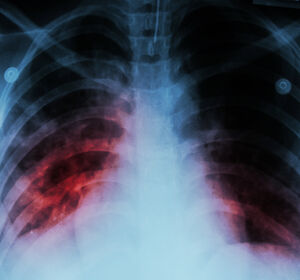 Neuer Biomarker ermöglicht Prognose von Nervenschäden bei Tuberkulosebehandlung