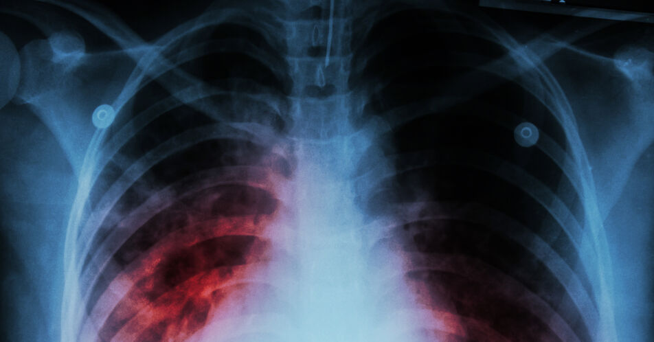 Neuer Biomarker ermöglicht Prognose von Nervenschäden bei Tuberkulosebehandlung