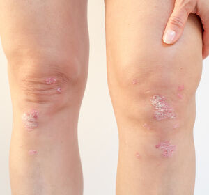 Psoriasis-Arthritis: Real-World-Daten zur Wirksamkeit von Ixekizumab