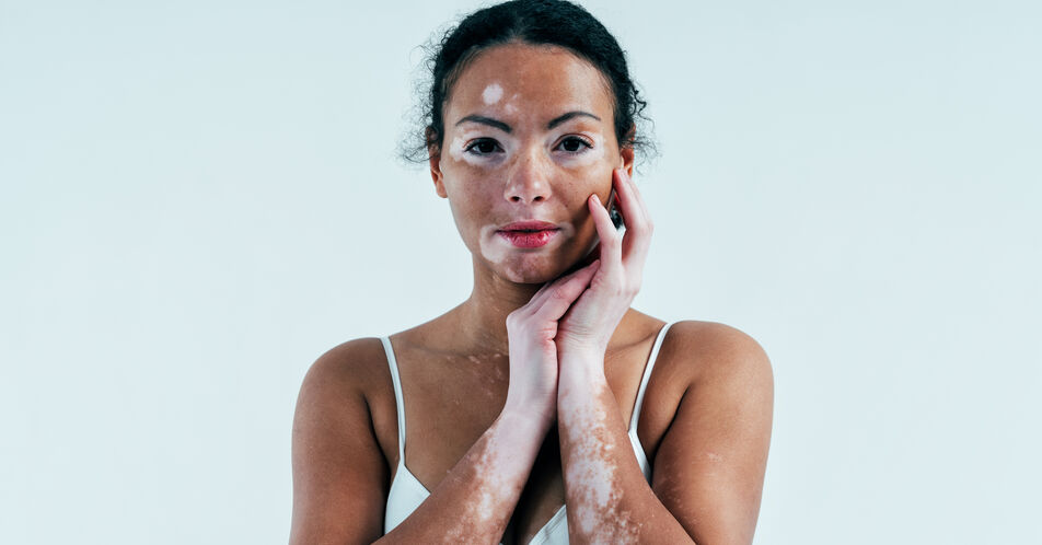 Vitiligo – die Autoimmunerkrankung verstehen, erkennen und patientengerecht behandeln