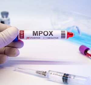 Gesundheitsämter in Deutschland sind auf Mpox vorbereitet