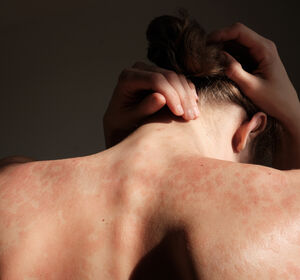 EADV-Kongress 2024: Neue Forschung bestätigt Zusammenhang zwischen empfundenem Stress und Psoriasis-Schub