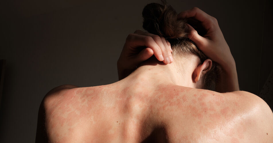 EADV-Kongress 2024: Neue Forschung bestätigt Zusammenhang zwischen empfundenem Stress und Psoriasis-Schub