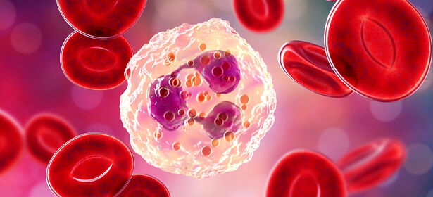 Die+chronische+Neutrophilenleuk%C3%A4mie+%E2%80%93+eine+seltene+Erkrankung+mit+schlechter+Prognose