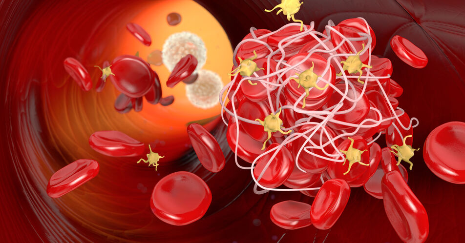 Neuer Mechanismus bei Venenthrombosen entdeckt – Thrombozyten als therapeutisches Ziel