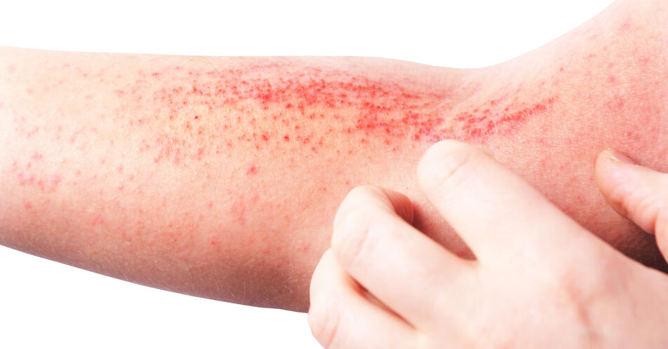 Langzeitdaten zur Wirksamkeit von Biologika bei atopischer Dermatitis und Psoriasis