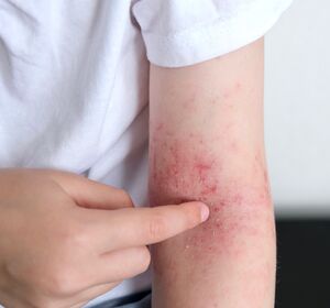 Upadacitinib bei atopischer Dermatitis – Zulassungserweiterung für Jugendliche