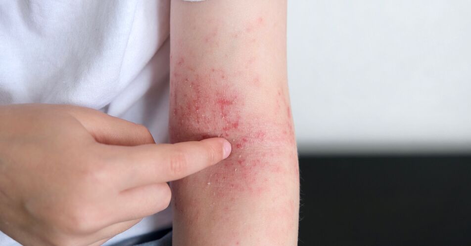 Upadacitinib bei atopischer Dermatitis – Zulassungserweiterung für Jugendliche