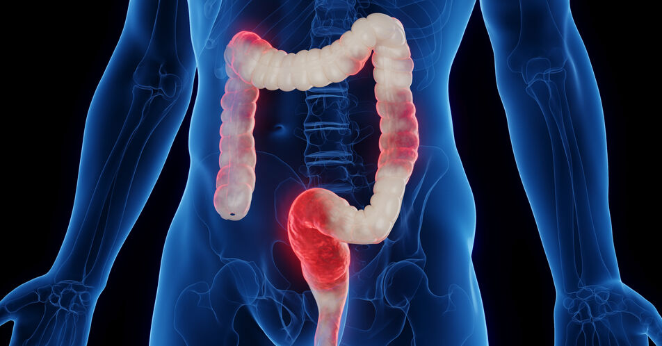 Mirikizumab bei Colitis ulcerosa: Langanhaltend starkes Ansprechen über einen Zeitraum von 3 Jahren