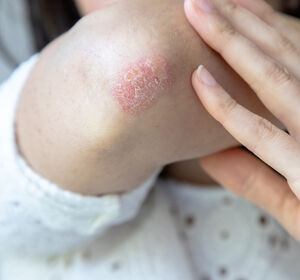 Real-World-Daten zu Secukinumab: Rund zwei Drittel der Plaque-Psoriasis-Patient:innen nach 5 Jahren immer noch fast symptomfrei