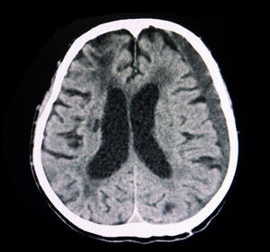 Embolisation der harten Hirnhautarterie bei chronisch subduralem Hämatom