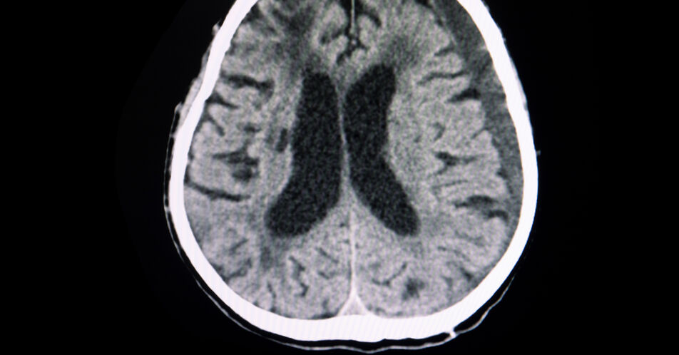 Embolisation der harten Hirnhautarterie bei chronisch subduralem Hämatom