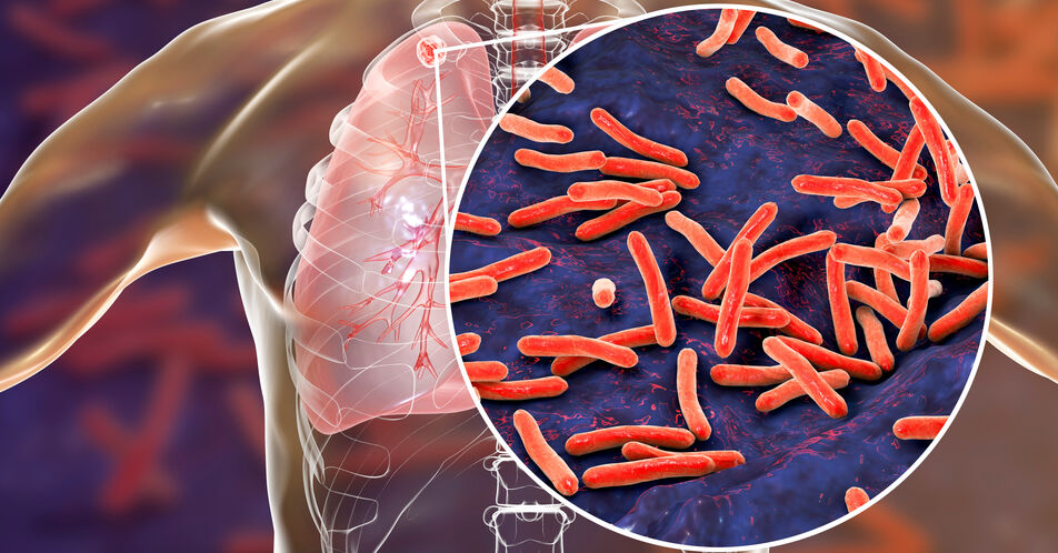 Neues Antibiotikum zur Behandlung der Tuberkulose